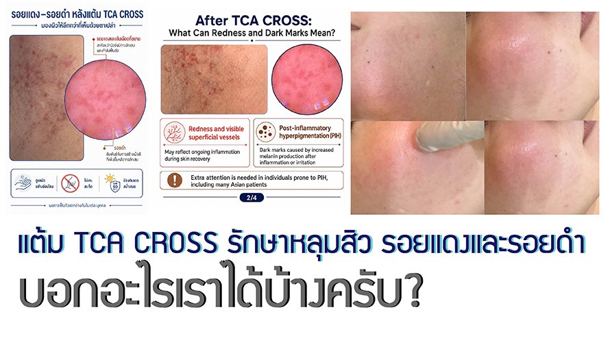 แต้ม TCA CROSS รักษาหลุมสิว รอยแดงและรอยดำ บอกอะไรเราได้บ้างครับ?